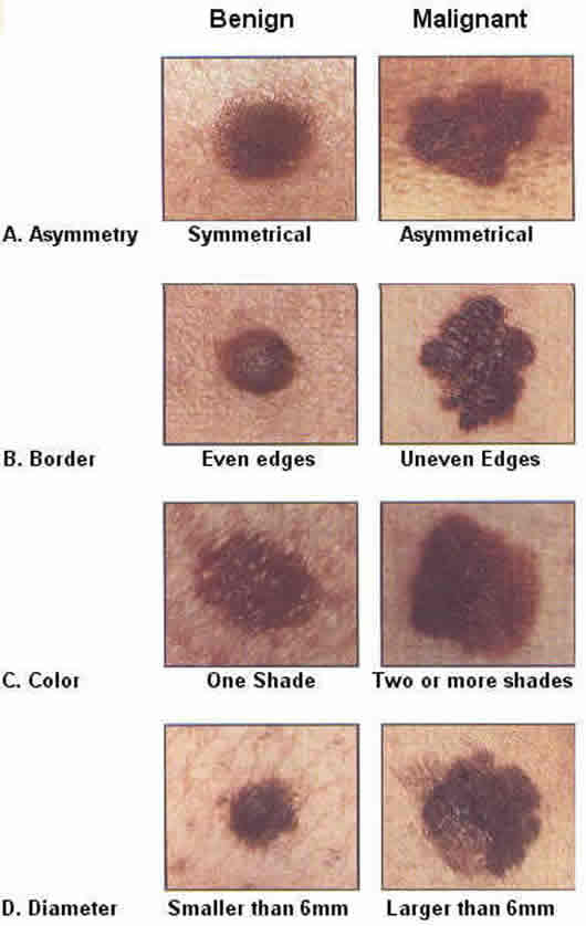 What Does An Unhealthy Mole Look Like Spotting Warning Signs