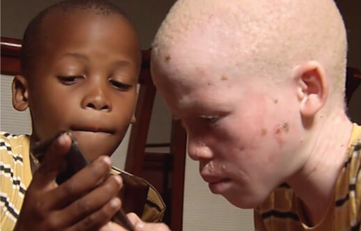 Sunscreen for Albinism