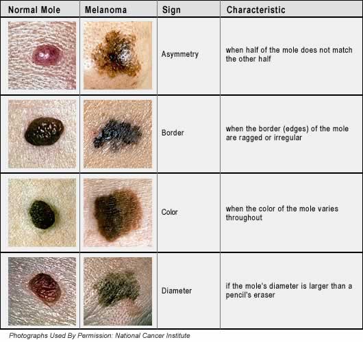 Pictures of cancerous moles